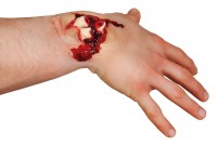 Preview: Bloody bone fracture latex application